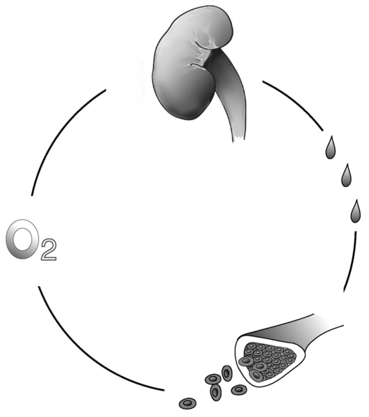 Illustration of a diseased kidney that fails to produce enough erythropoietin to stimulate red blood cells, resulting in anemia.