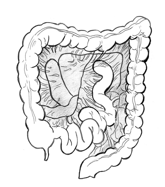 Illustration of the colon and the mesentery, which holds the colon in place.