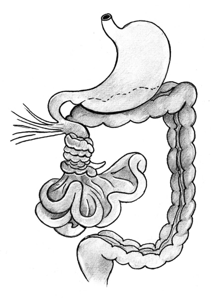 Illustration of volvulus in which a portion of the intestine twists around itself.