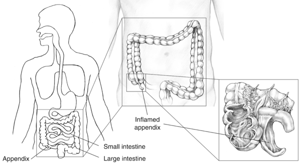 Illustration of the appendix, small intestine, and large intestine with a detail of an inflamed appendix and each labeled.