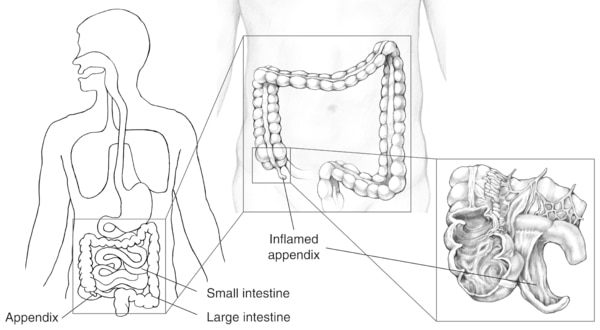 Illustration of the appendix, small intestine, and large intestine with a detail of an inflamed appendix and each labeled.