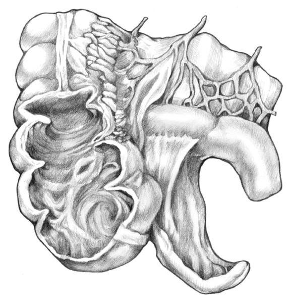 Illustration of an inflamed appendix.