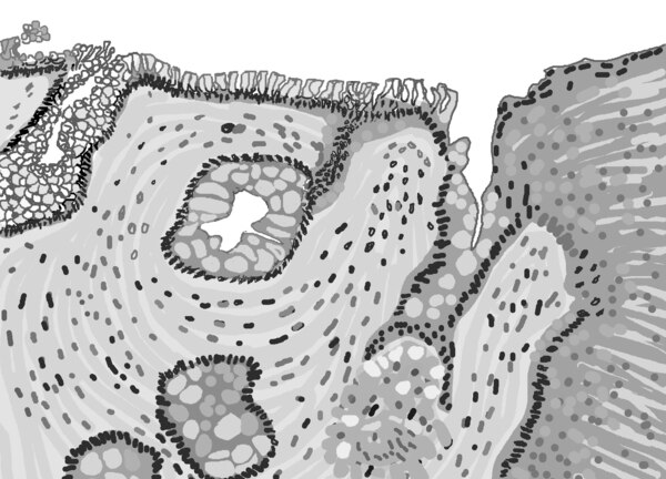 Illustration of a microscopic piece of the esophagus showing the abnormal tissue of Barrett’s esophagus.