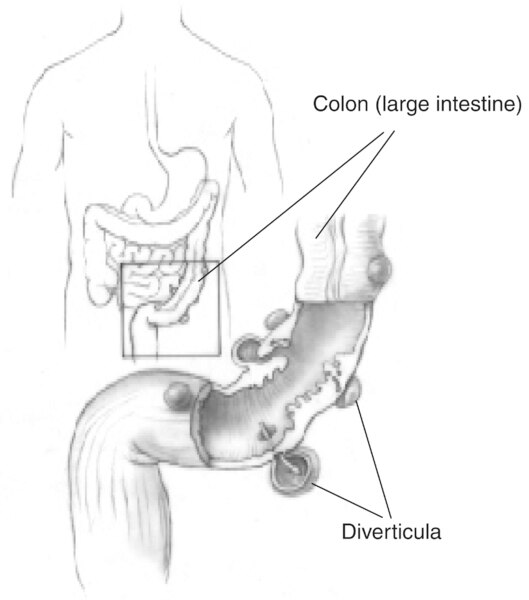 Illustration of the colon and an enlargement of it showing diverticula with colon (large intestine) and diverticula labeled.
