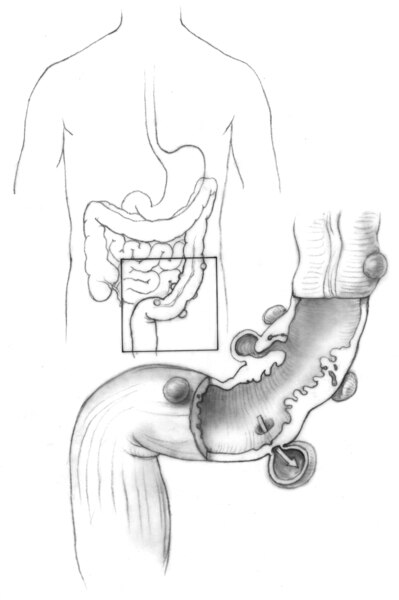 Illustration of the colon and an enlargement of it showing diverticula.