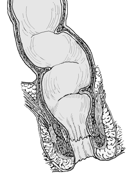 Illustration of cross section of the rectum and anus.