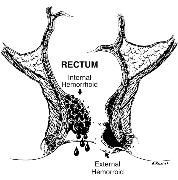 Illustration of the rectum with an internal hemorrhoid and an external hemorrhoid labeled.