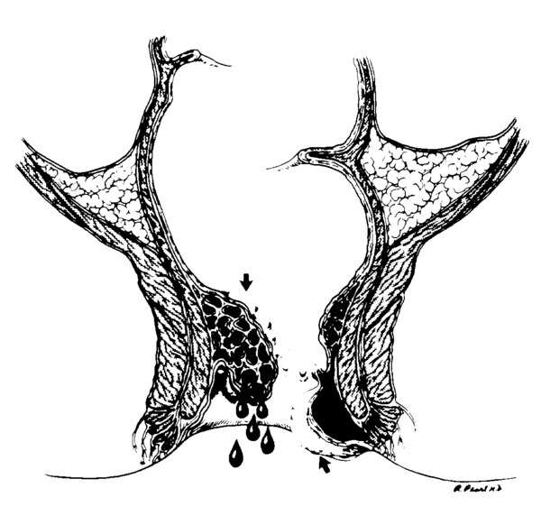 Illustration of the rectum with an internal and an external hemorrhoid.