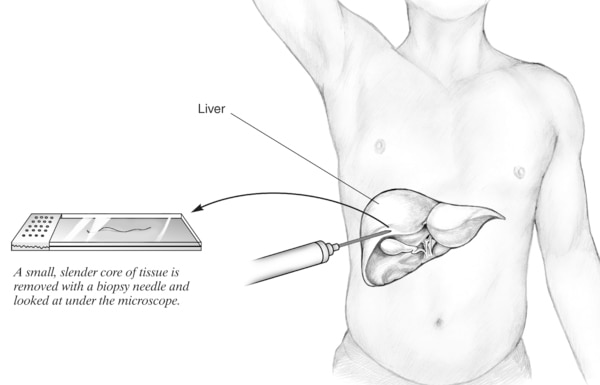 Illustration of a liver biopsy procedure and a slide with tissue sample, with the text: "A small, slender core of tissue is removed with a biopsy needle and looked at through a microscope."