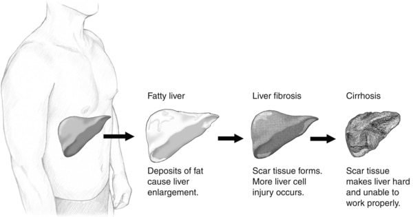 Illustration of the stages of liver damage: normal liver, fatty liver (where deposits of fat cause liver enlargement), liver fibrosis (where scar tissue forms and more liver cell injury occurs), and cirrhosis (where scar tissue makes the liver hard).