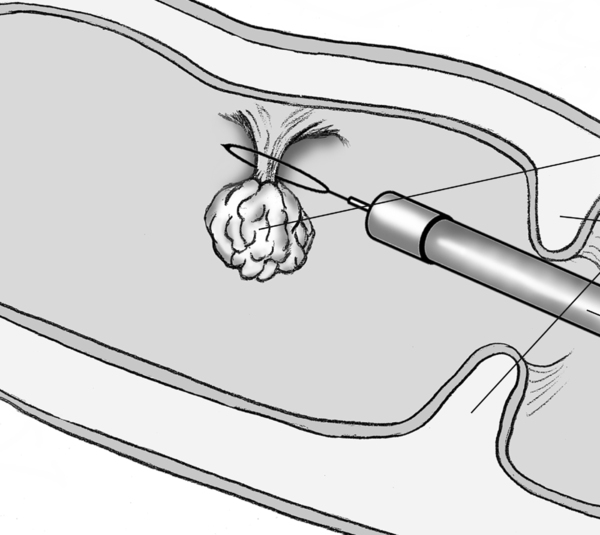 Illustration of a polyp removal, labeled.