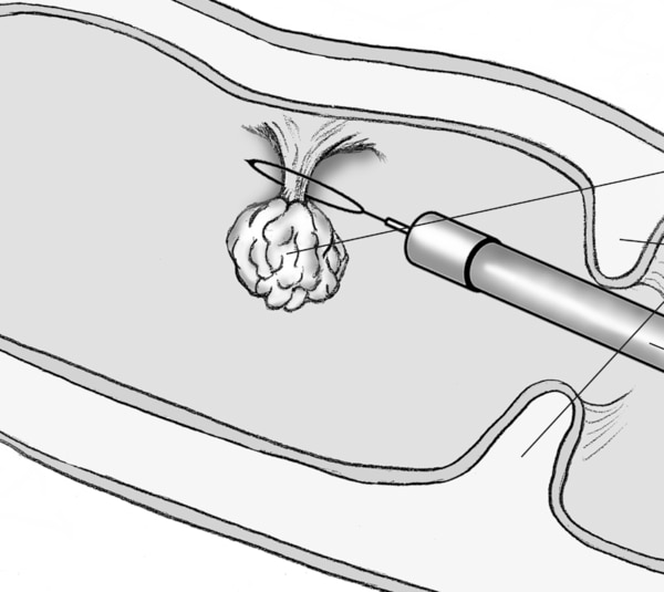 Illustration of a polyp removal, labeled.