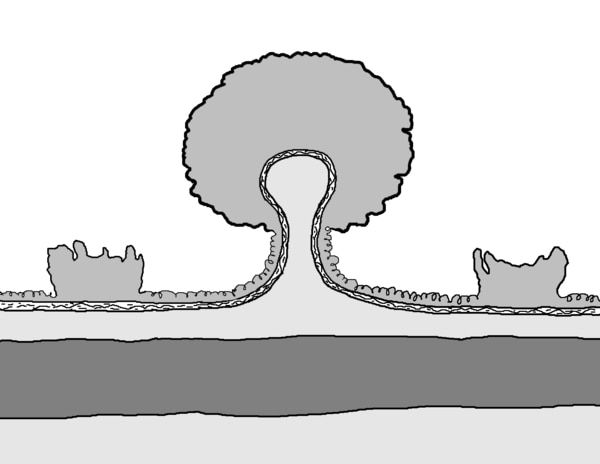 Illustration of two normal intestinal folds and one polyp.