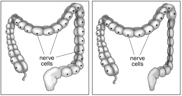Two illustrations of the large intestine, one showing healthy nerve cells and one showing nerve cells missing from the last part of the intestine in Hirschsprung's disease. Nerve cells are labeled in both.