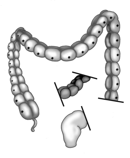 Illustration of the large intestine section missing nerve cells detached from the healthy section and the rectum.