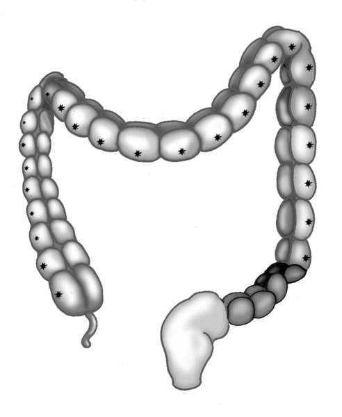 Illustration of the large intestine with section missing nerve cells, rectum, and anus.