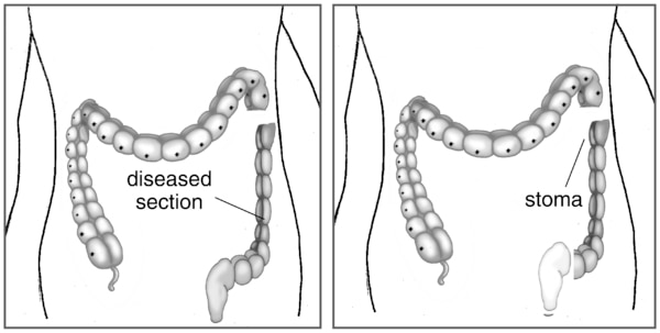 Two illustrations of ostomy surgery. The first shows the large intestine with the diseased section labeled and detached from the healthy section. The second shows the healthy section attached to a stoma labeled.