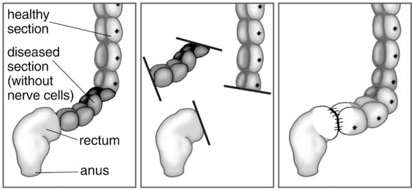 Three illustrations of pull-through surgery to treat Hirschsprung’s disease. The first shows a healthy section and a diseased section following the anus. The second shows removal of the diseased section. The third shows the healthy section gets attached t