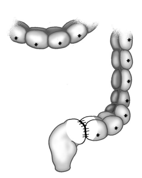 Illustration of the large intestine, rectum, and anus after pull-through surgery.