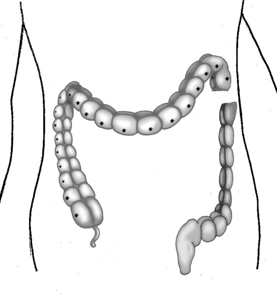 Illustration of the large intestine with diseased section detached from healthy section.