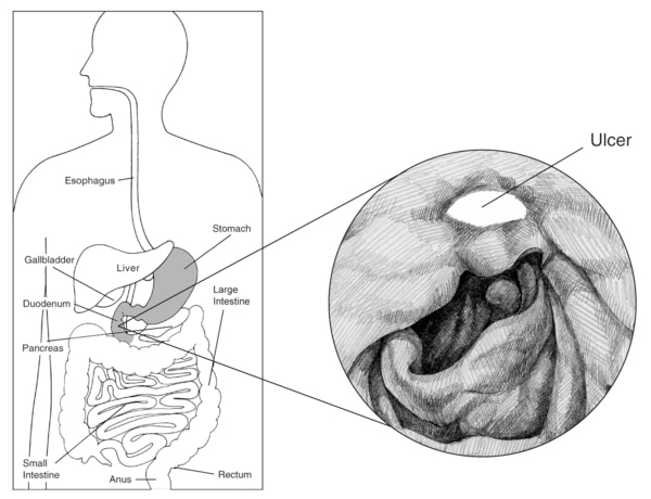 Illustration of the digestive system with the esophagus, stomach, liver, gallbladder, duodenum, pancreas, small intestine, large intestine, rectum, and anus labeled. Inset drawing shows a peptic ulcer with the ulcer labeled.
