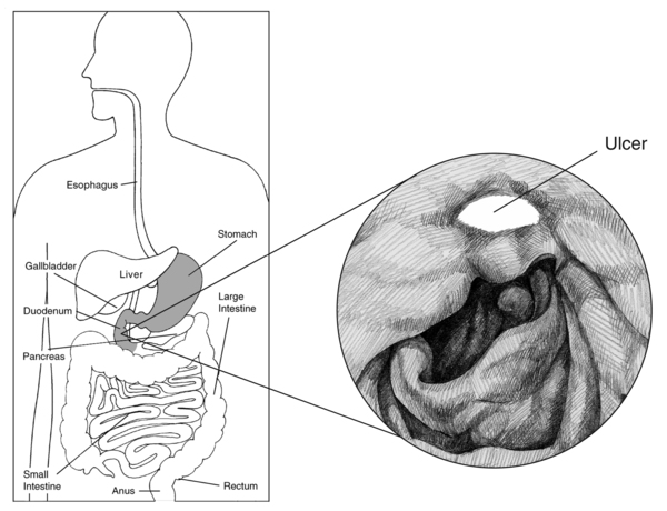 Illustration of the digestive system with the esophagus, stomach, liver, gallbladder, duodenum, pancreas, small intestine, large intestine, rectum, and anus labeled. Inset drawing shows a peptic ulcer with the ulcer labeled.