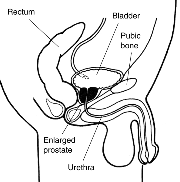 Illustration of the male urinary tract showing how an enlarged prostate can squeeze the urethra and block urine flow.