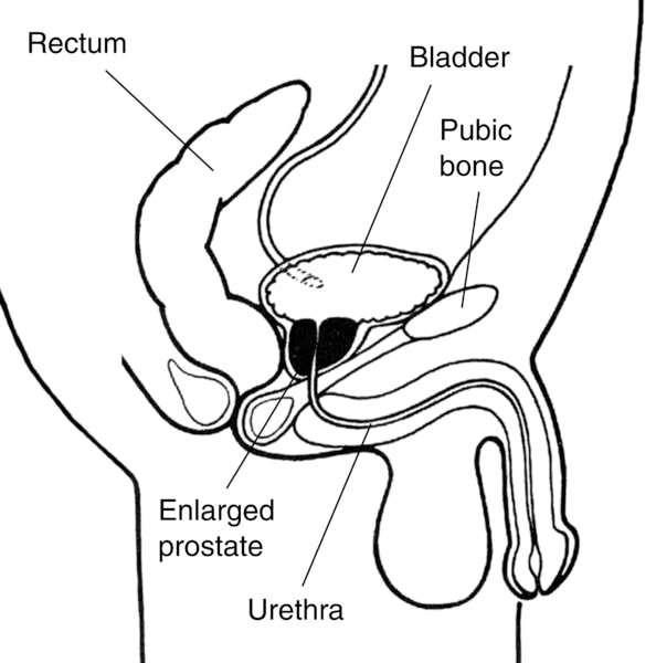Illustration of the male urinary tract showing how an enlarged prostate can squeeze the urethra and block urine flow.