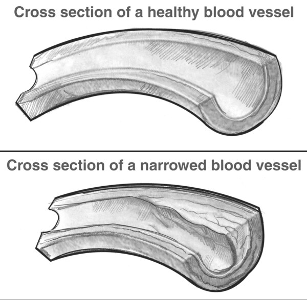 Two illustrations of cross sections of blood vessels, healthy and narrowed.