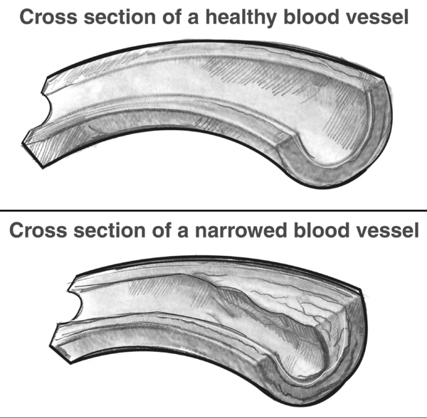 Two illustrations of cross sections of blood vessels, healthy and narrowed.