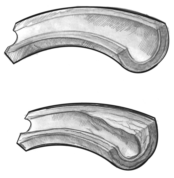 Two illustrations of cross sections of blood vessels, one healthy and one clogged.