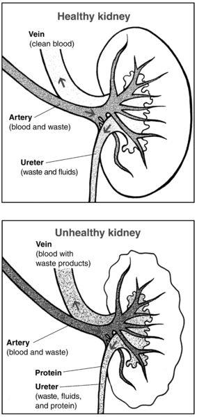 Two illustrations of kidney cross sections, with the functions labeled, showing a healthy kidney and an unhealthy kidney.