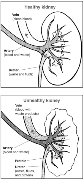 Two illustrations of kidney cross sections, with the functions labeled, showing a healthy kidney and an unhealthy kidney.