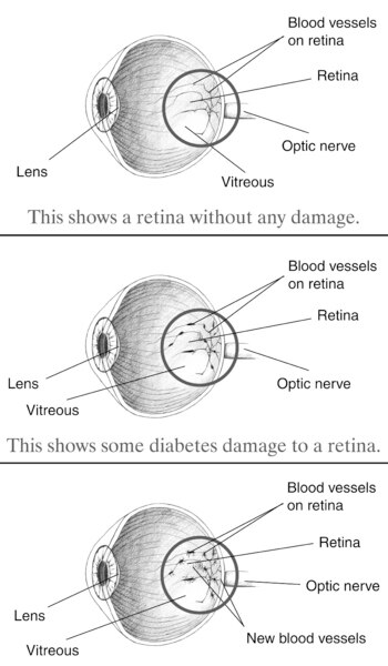Illustration of three eye balls.  The top eyeball is healthy, while the lower two are not.