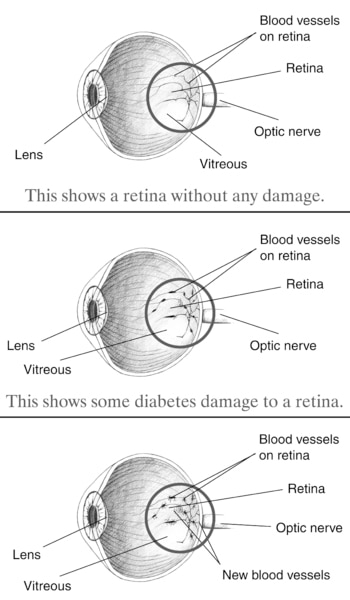 Illustration of three eye balls. The top eyeball is healthy, while the lower two are not.