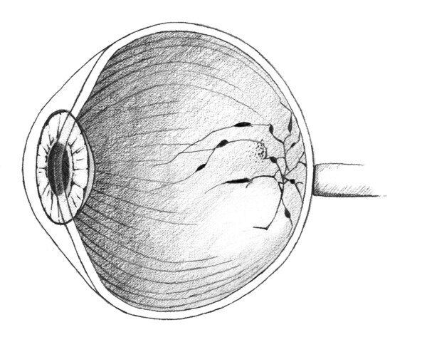 Illustration of an eye that is sketched.  The retina of the eye is infected.