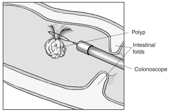 Drawing of a colon polyp being removed by a colonoscope with labels pointing to the polyp, colonoscope, and two intestinal folds. The wire loop at the end of the colonoscope is around the base of the polyp.