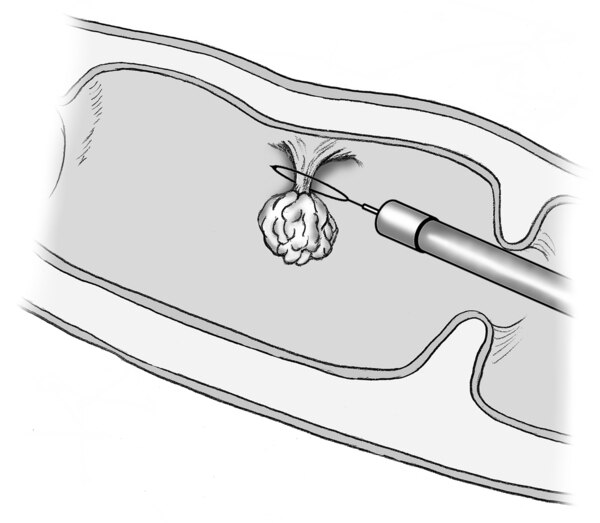Drawing of a colon polyp being removed with a small instrument.