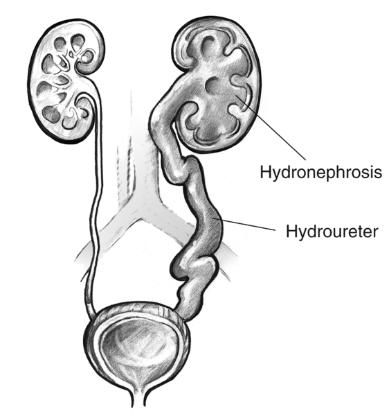 Drawing of swollen kidney and ureter. The swollen kidney is labeled hydronephrosis. The swollen ureter is labeled hydroureter.