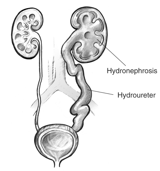 Drawing of swollen kidney and ureter. The swollen kidney is labeled hydronephrosis. The swollen ureter is labeled hydroureter.