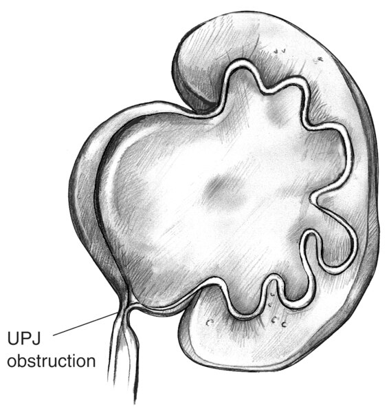Drawing of a swollen kidney that results from ureteropelvic junction obstruction. The point of blockage is labeled UPJ obstruction.