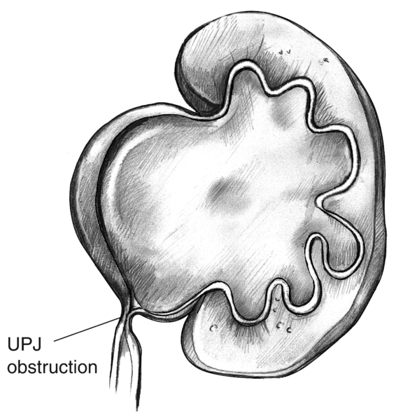 Drawing of a swollen kidney that results from ureteropelvic junction obstruction. The point of blockage is labeled UPJ obstruction.