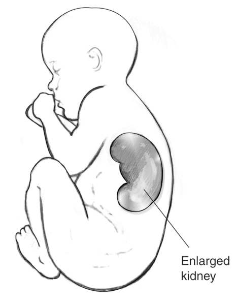 Drawing of a fetus with an enlarged kidney visible, as seen in an ultrasound. The enlarged kidney is labeled.