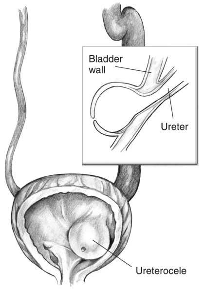 Front-view, cross-section drawing of a bladder and ureter showing a ureterocele. An inset shows a side-view cross section of the obstructed ureter.