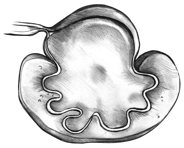 Drawing of a swollen kidney that results from ureteropelvic junction obstruction. The point of blockage is labeled UPJ obstruction.