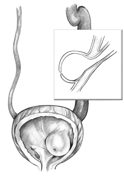 Front-view, cross-section drawing of a bladder and ureter showing a ureterocele. An inset shows a side-view cross section of the obstructed ureter.