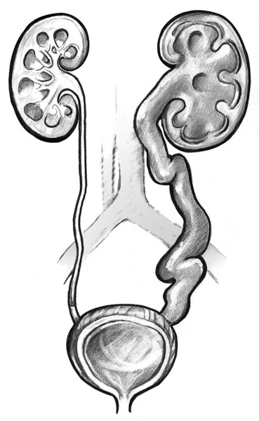 Drawing of swollen kidney and ureter. The swollen kidney is labeled hydronephrosis. The swollen ureter is labeled hydroureter.