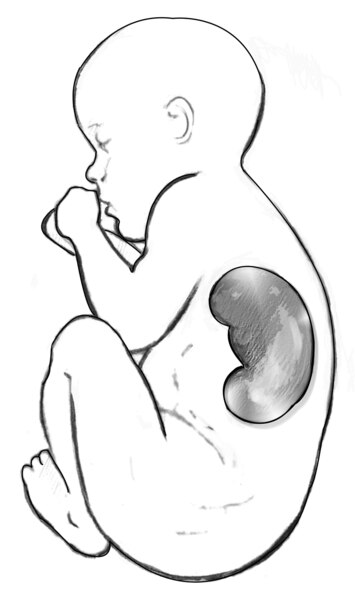 Drawing of a fetus with an enlarged kidney visible, as seen in an ultrasound.
