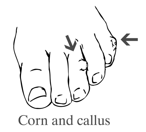 Drawing of a foot showing a corn and a callus.