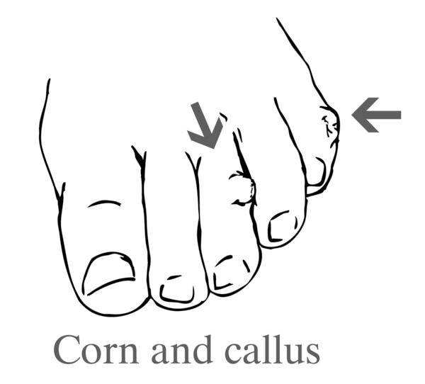 Drawing of a foot showing a corn and a callus.